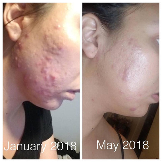 Super Acne Fighter / Organic Acne Treatment / Acne - Cart2u.ro