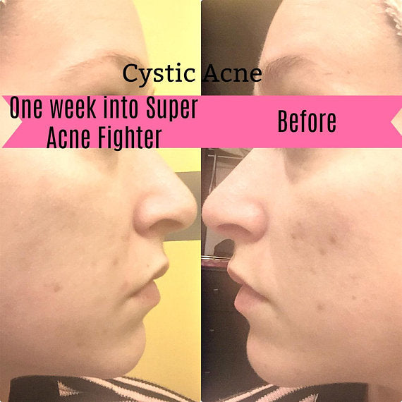 Super Acne Fighter / Organic Acne Treatment / Acne - Cart2u.ro